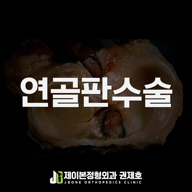 외측 반월상 연골판 절제술 resection / 제이본정형외과 권제호