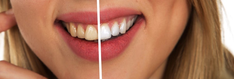 치아미백을 위한 방법 및 관리법