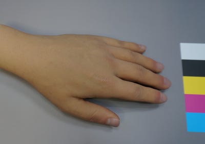  선천성 손기형에도 맞춤 실리콘 의수로 내 손처럼 제작하세요.
