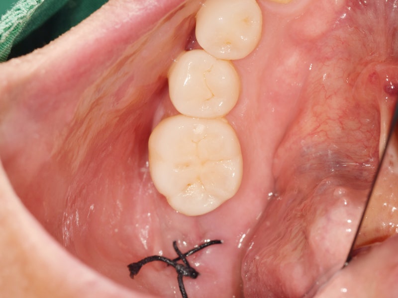 신길동 임플란트 염증 무시하면 어떻게 될까 2