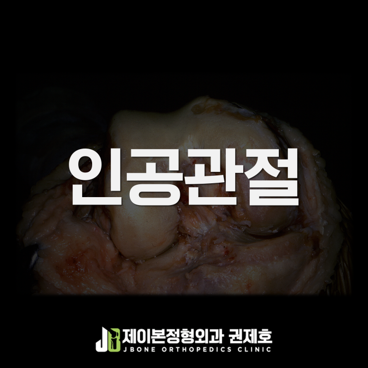 무릎 인공관절수술 arthroplasty / 제이본정형외과 권제호