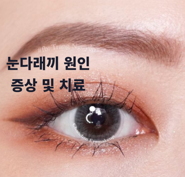  [눈 다래끼] 눈 다래끼 원인과 증상 및 치료