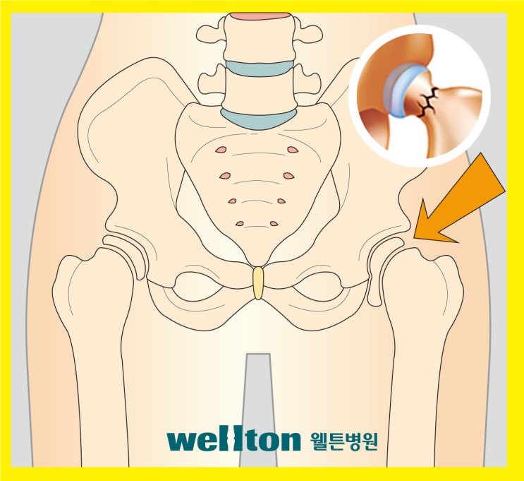  엉덩이관절 골절 위험, 골다공증검사로 미리예방하자