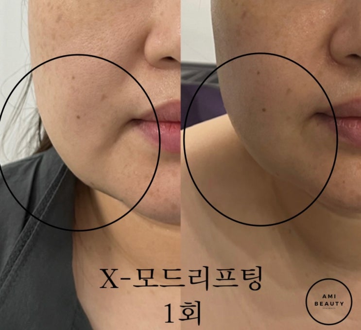 [대구 피부관리 아미뷰티] 극강의 리프팅 성형한듯 수술효과 리프팅 1회 