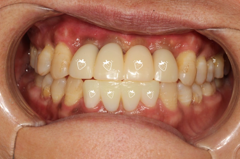 신길동 임플란트 염증 무시하면 어떻게 될까 7