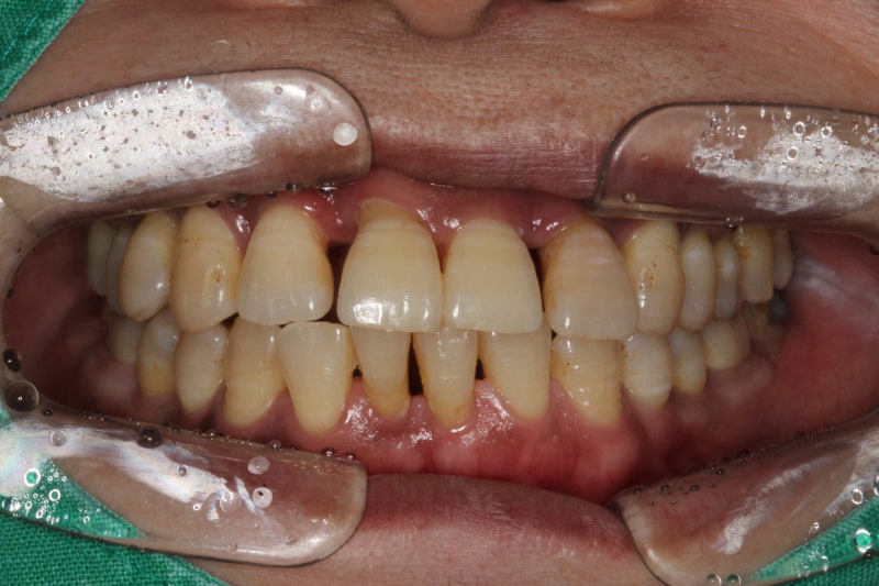 신길동 임플란트 염증 무시하면 어떻게 될까 4