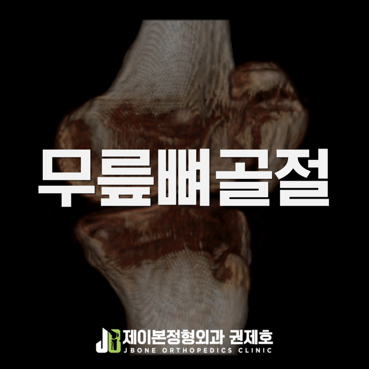 무릎뼈골절 patella 1년 후기 / 제이본정형외과 권제호