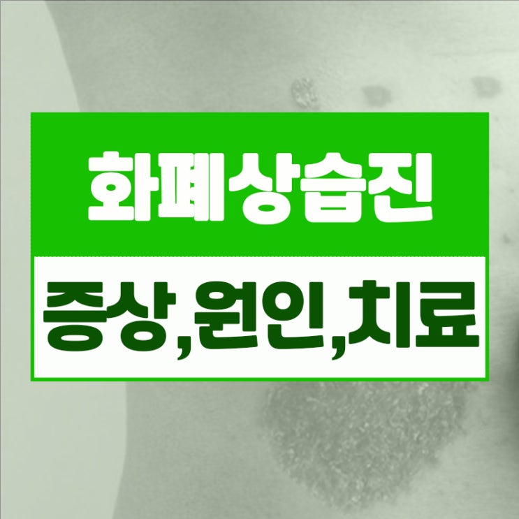  진물나고 가려운 화폐상습진 원인과 치료 알아보기