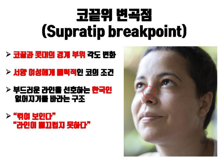  코의 시작점부터 코끝까지 매끄러운 코라인을 위한 무보형물 코수술!!!