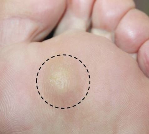 표피낭종 원인 및 증상과 수술 제거 방법 정리(피지낭종 병원 실비 보험) : 네이버 블로그