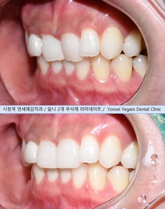 [Seoul,Yonsei Yegam Dental Clinic] Inturned tooth ->Veneer treatment