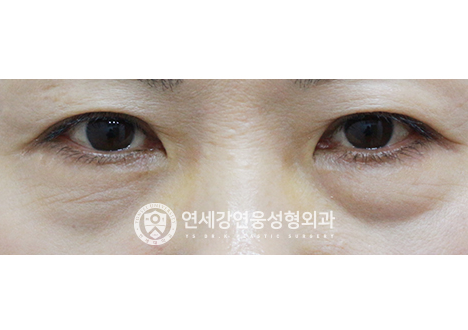 청주성형외과 눈하하하안검의 지방재배치 효과 차이 비교