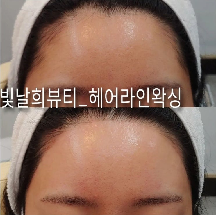  이마필러 고민중이시라면 양산빛날희왁싱에서 헤어라인왁싱 먼저 추천드려요