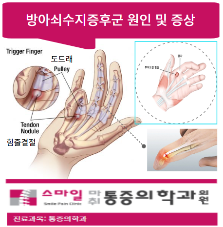  [일산마취통증의원] 방아쇠수지증후군 원인 및 증상에 대해 알아봅시다!