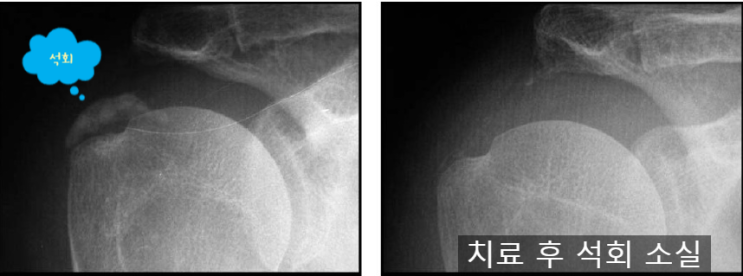  부산 어깨통증, 석회성건염이 뭐에요? [진단편][논문]