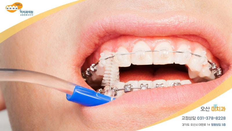 버팀대가 떨어져도 상관없나요?치열 교정