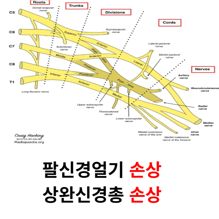  팔신경얼기손상(상완신경총손상) 유형 9가지