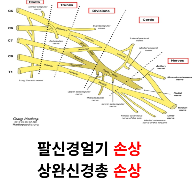 팔신경얼기손상(상완신경총손상) 유형 9가지