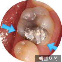  오래된 아말감 변색 및 이차충치 - 통증생겨서 신경치료 하고 크라운으로 교체한 케이스
