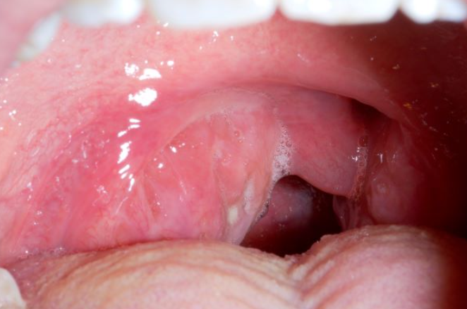  편도(Tonsil) - 전염성 단핵구증(Infectious mononucleosis), 편도 주위 농양(Peritonsillar abscess), 편도결석(Tonsillolith)