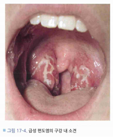  편도(Tonsil) - 편도염(Tonsillitis), 아데노이드염(Adenoiditis)