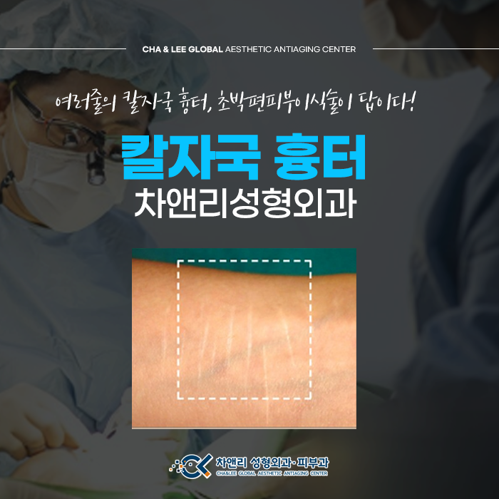  여러줄의 칼자국흉터는 초박편피부이식술로