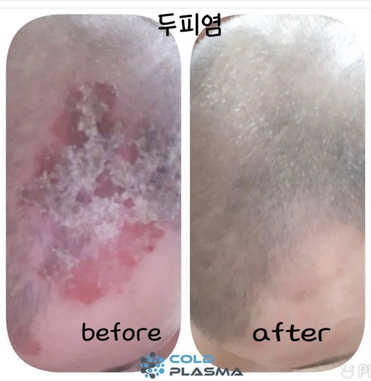  [대구 피부관리 아미뷰티] 지루성피부염 그냥두지마세요 탈모의원인입니다