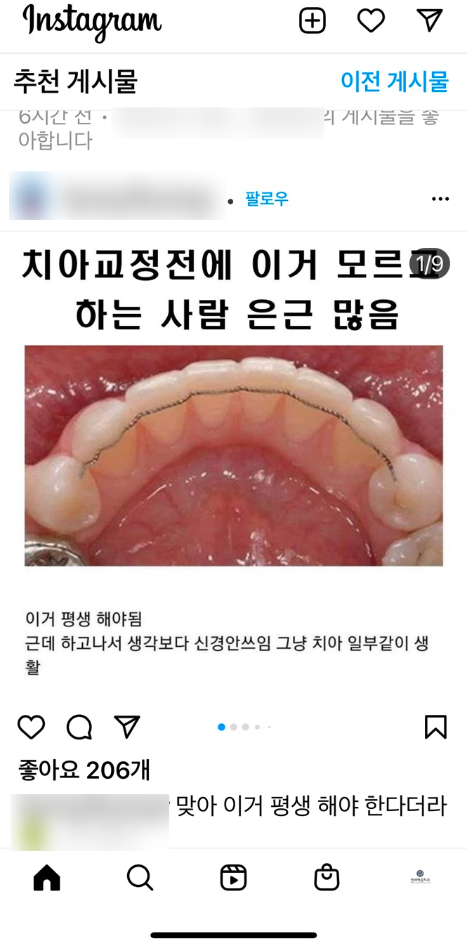 I had braces, but my front teeth are crooked→Case of partial front teeth correction (re-calibration)