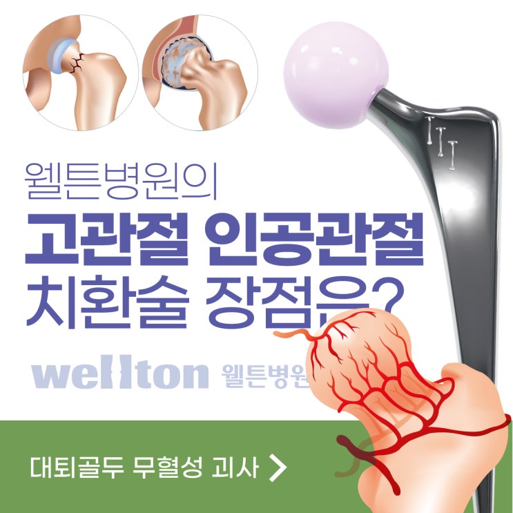  웰튼병원, 고관절 인공관절 치환술의 장점