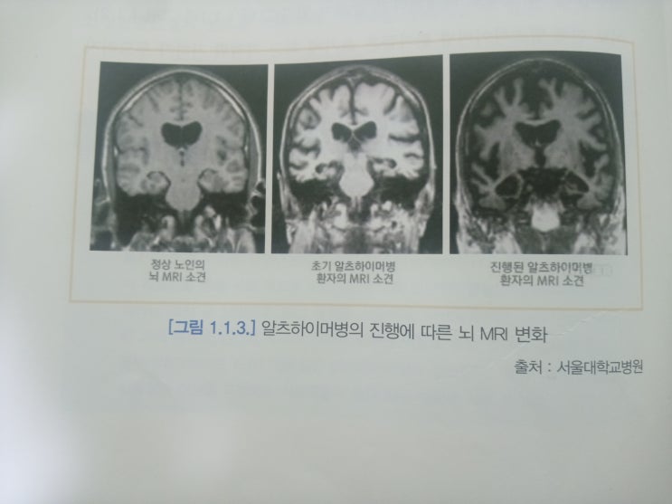  치매의 원인과 종류
