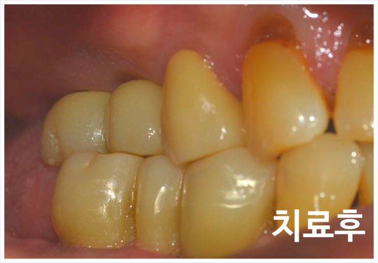  은평구임플란트< 의사는 나에게 꼭 필요한 치료를 권하는 것일까?>