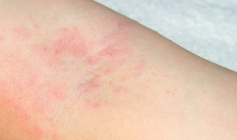 면역력 저하 두드러기 근황 10차 (11.18) 3