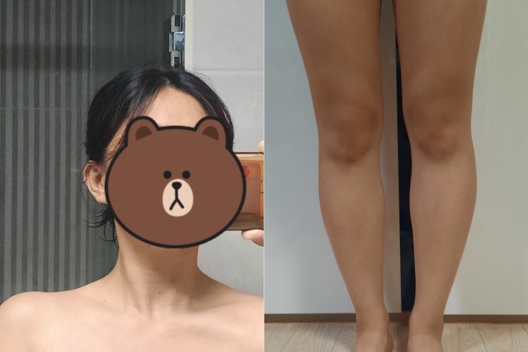  강남 승모근 종아리 보톡스 후기 주사 효과, 가격 *32일차