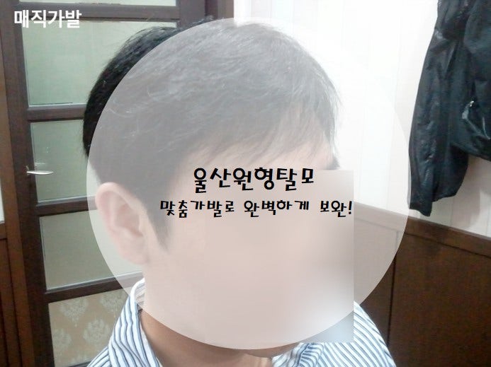 울산 남자가발, 정수리 탈모 맞춤가발로 완벽 보완!