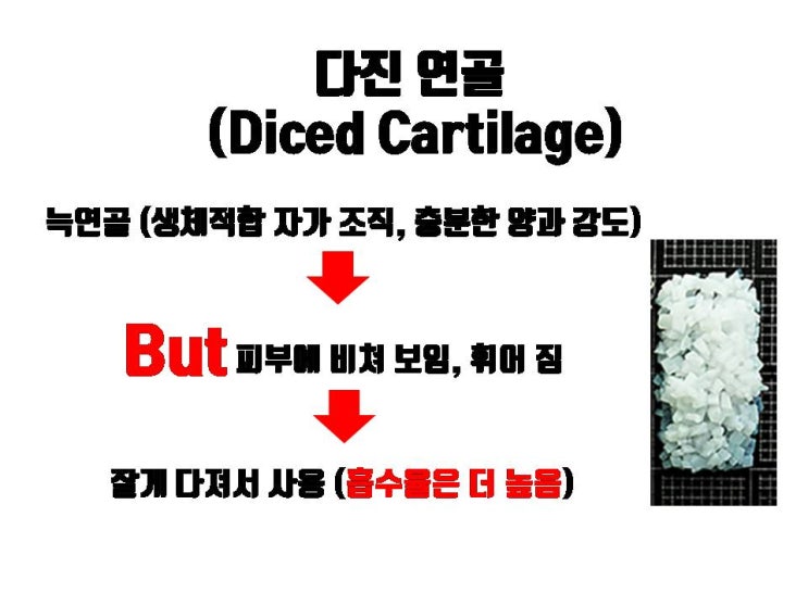  늑연골을 다져서 (다진 늑연골) 무보형물 코성형 시 사용할 수도 있어요!!!