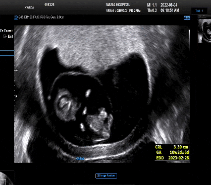 임신초기 일란성쌍둥이 9주 10주 입덧 증상 임신선과 튀어나온 배