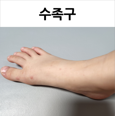  4세 수족구 잠복기 증상과 격리기간, 뭐 먹이면 좋을까?