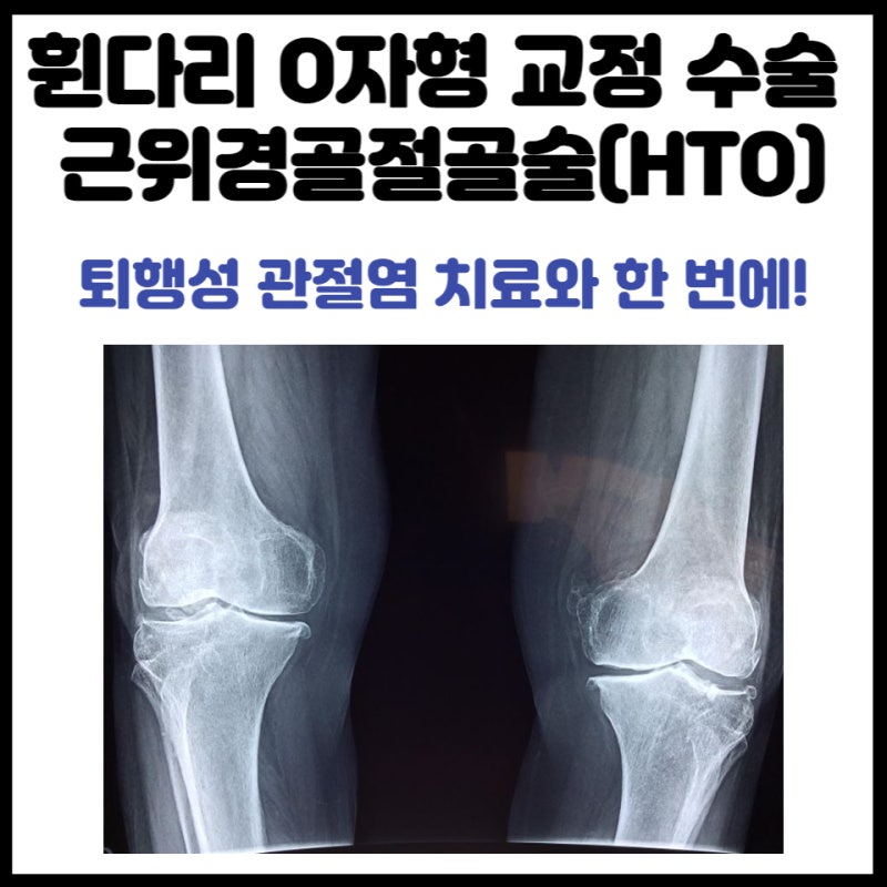 굽은다리교정&오다리교정 강서구 근위경 골절술은 서울원병원에서! (WITH커티스템_무릎줄기세포)