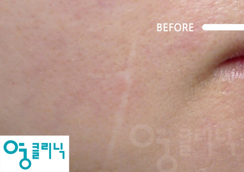 켈로이드흉터제거 치료 말끔히 관리하도록