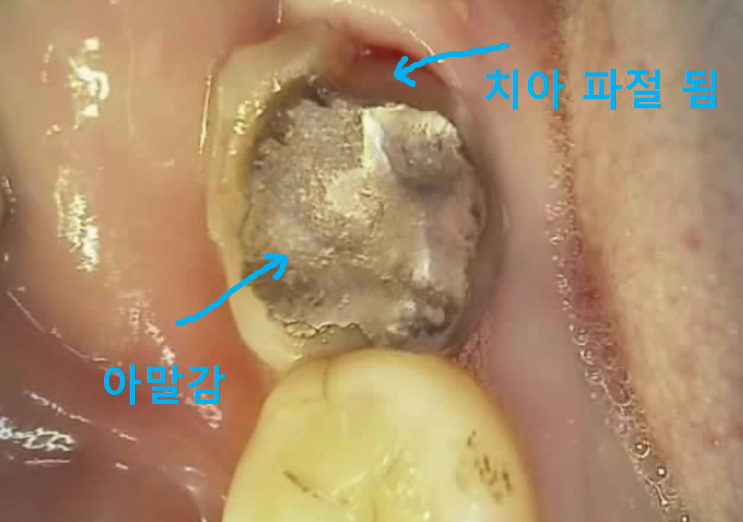 하남 풍산동치과 깨진 아래 어금니의 크라운 치료