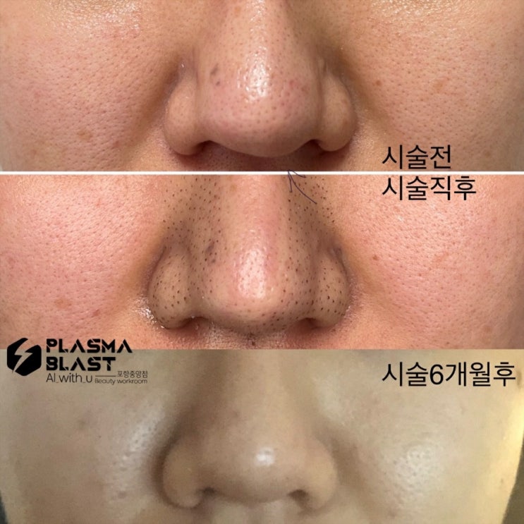  [대구 피부관리 아미뷰티] 코 블랙헤드/피지 고민은 콜드플라즈마로 날려버리세요~~