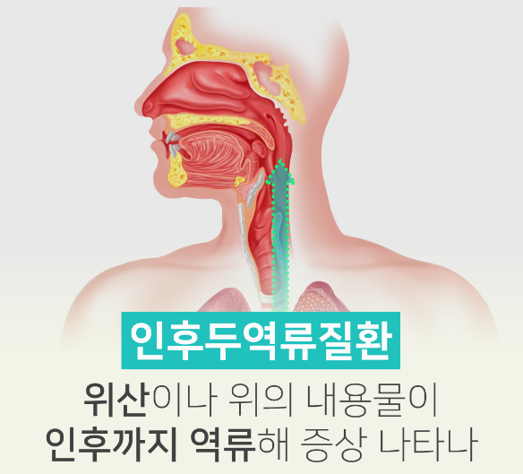  인후두 역류질환(Laryngopharyngeal reflux disease, LPRD) - 목이 갑갑하고 불편해요, 목 안쪽이 칼칼해요, 마른 기침이 계속 나와요, 목소리가 잠겨요
