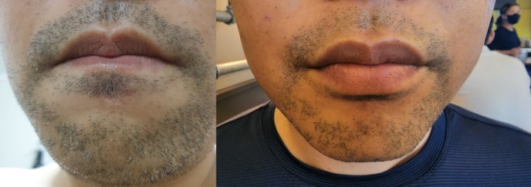 남자수염제모 수염자국 없애기 강남역 피부과 레이저 2주 후기 가격 횟수 관리법 추천
