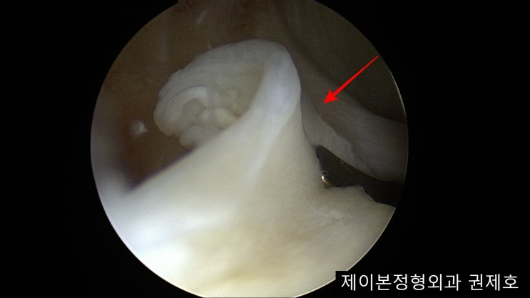  무릎연골찢어짐 관절경적 subtotal 아전절제술