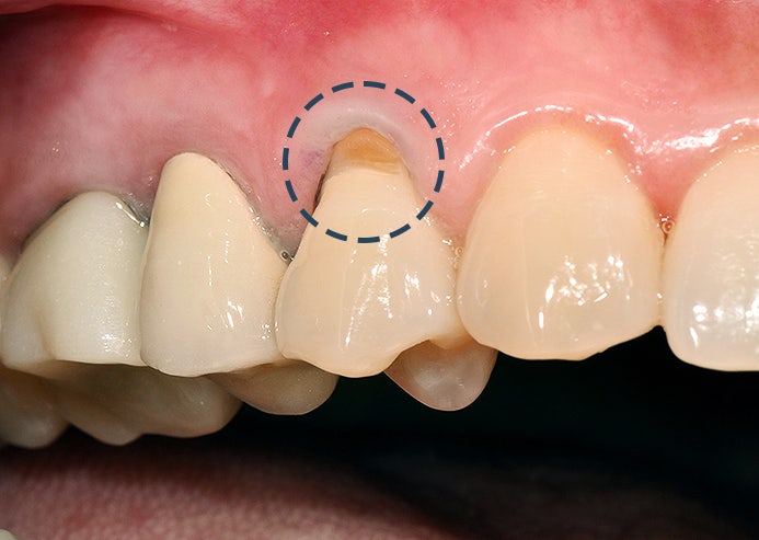 스케일링이 시린 걱정이라면? 11