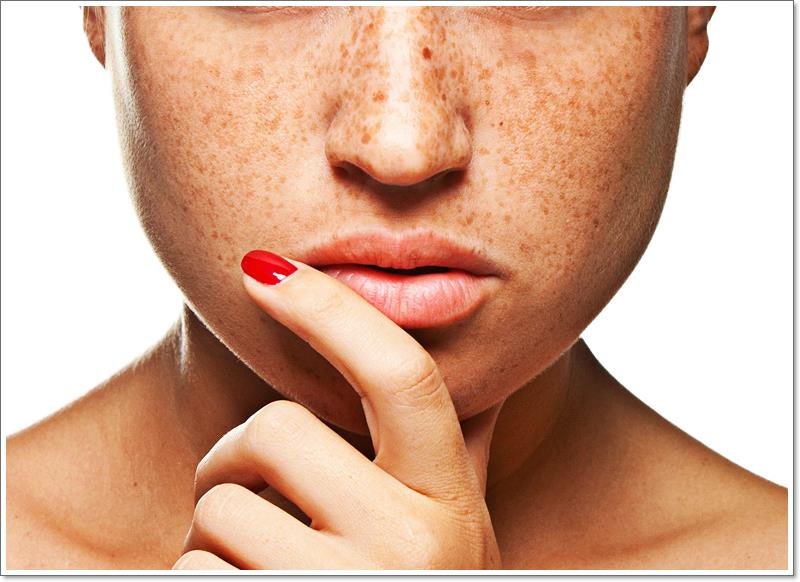 주근깨가 생기는 이유를 알아보고 관리해주세요.