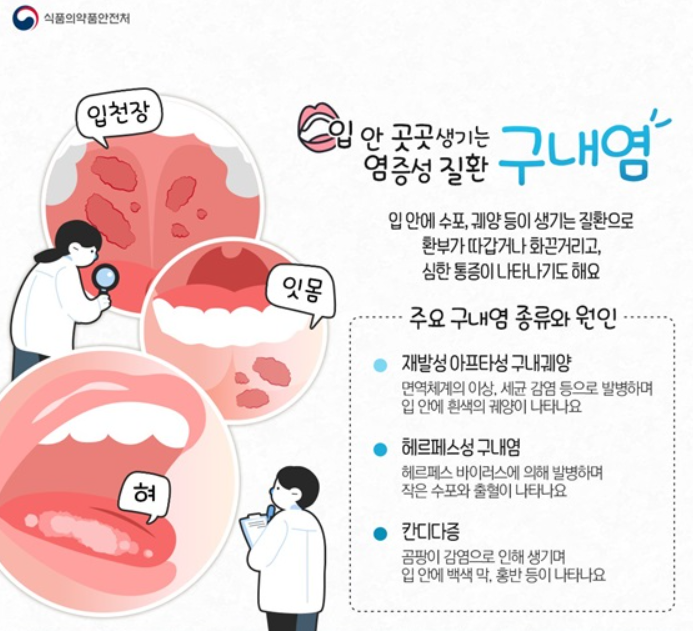  구강과 구인두의 양성 질환 (1) - 재발성 아프타성 입안염(구내염), 백반증, 편평태선, 적색반(홍반증), 지도혀, 고랑혀, 검은혀(흑모설), 구강 작열감 증후군