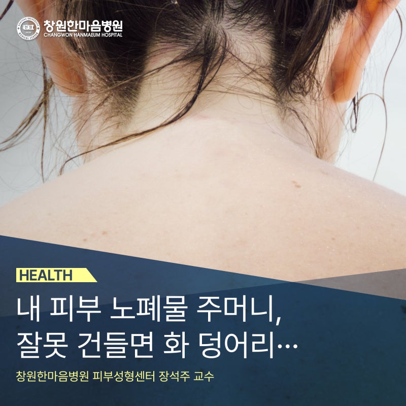 창원한마음병원, [표피낭종] 내 피부 노폐물 주머니, 잘못 건들면 화 덩어리···