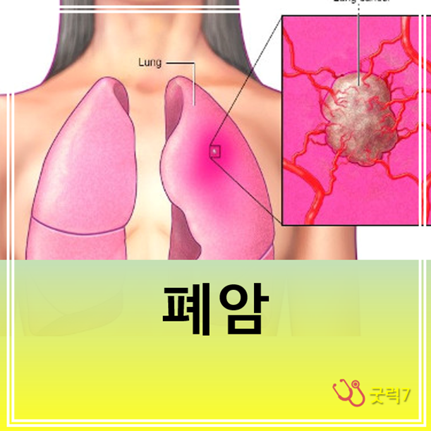 폐선암 2기 D02 폐암선암 보험금 수령! 폐선암 초기 C34.9