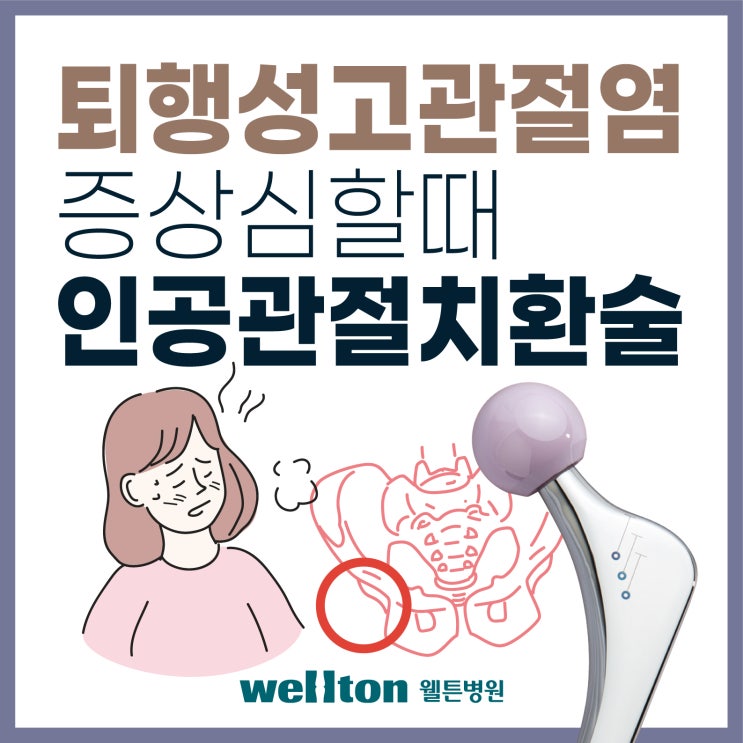  퇴행성고관절염, 증상 심할 때 고관절 인공관절치환술